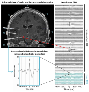 This figure illustrates the statistically significant contribution of deep brain electrical sources (here, the hippocampus) to the scalp EEG despite their depth relative to surface sensors, background brain noise (signal-to-noise ratio), and the geometric configuration of these sources (closed electric field)